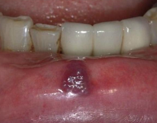 <p>What is one of the most common tumors of infancy, but can also occur in adults?</p>