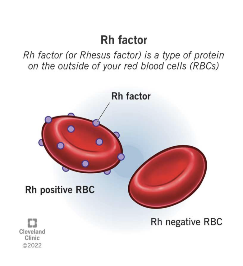 <ul><li><p>destruction of RBC’s faster than the body can repoduce them</p></li><li><p>Rh incompatibility</p><ul><li><p>Rh motehr and Rh+ fetus</p></li><li><p>maternal Rh antibodies corss placenta —> lysis of fetal RBC’s —> anemia</p></li><li><p>prenatal prevention method</p><ul><li><p>rhogam&nbsp;</p></li></ul></li></ul></li><li><p>ABO incompatibilyiy&nbsp;</p><ul><li><p>maternal blood type O exposed to fetabl blood type a, b or ab</p></li><li><p>result - hyperbilirubinemia</p></li></ul></li></ul><p></p>