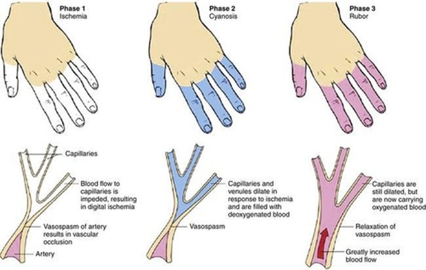 <p>Vasospasm of blood vessels which will prevent blood flow leading to colour changes in the extremities, nose, and ears</p><p>3 phases:</p><p>1. Whiteness - pallor dt ischaemia</p><p>2. Blueness - P.cyanosis dt vasodilation</p><p>3. Rubor - Normal flow</p><p>Primary Raynaud's disease:</p><p>Dt cold exposure and emotional stress</p><p>Secondary Raynaud's disease:</p><p>Dt pre-existing condition (RA)</p>
