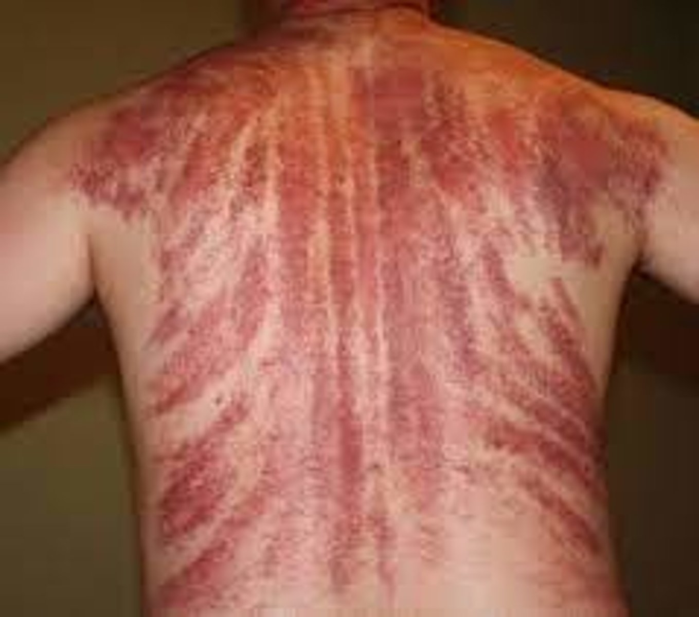 <p>-Alternative form of medicine</p><p>-Practiced in Southeast Asia</p><p>-Rubbing heated oil on the skin (chest, back, or shoulders)</p><p>-Vigorously rubbing of a coin in a linear fashion until red mark is seen</p><p>-Believed to allow "bad wind" to be released from body</p><p>-Used to treat fever, chills, headaches, colds, and cough</p>