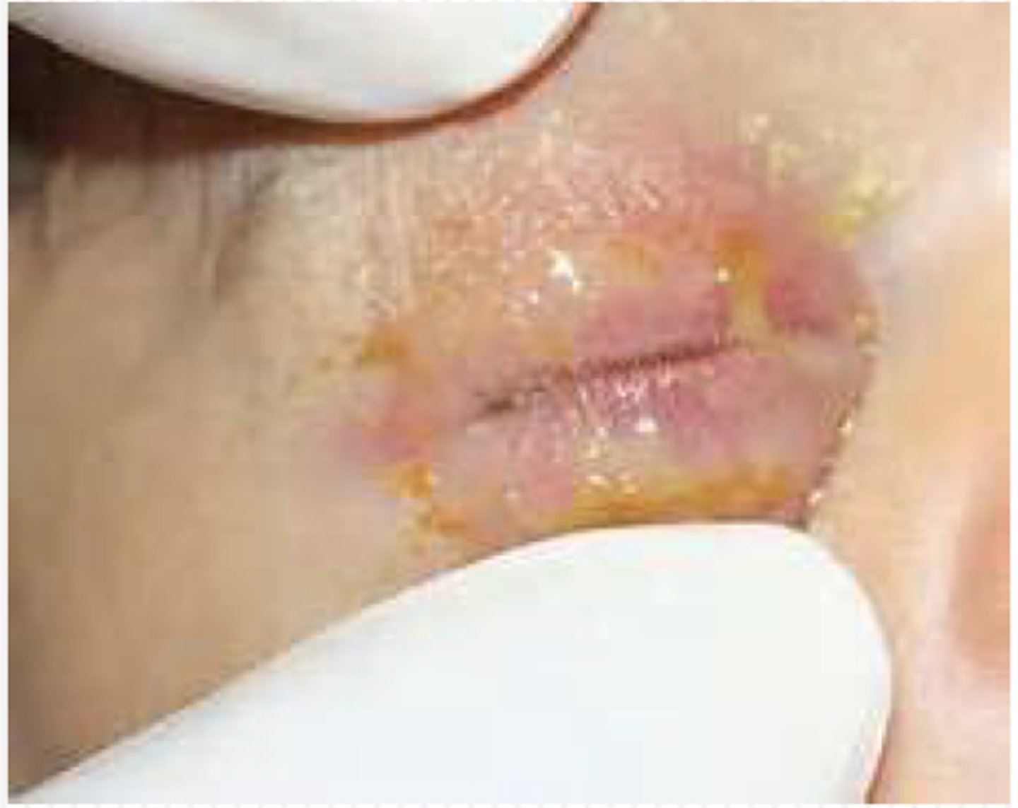 <p>- Conjunctivitis</p><p>- Pneumonia</p>