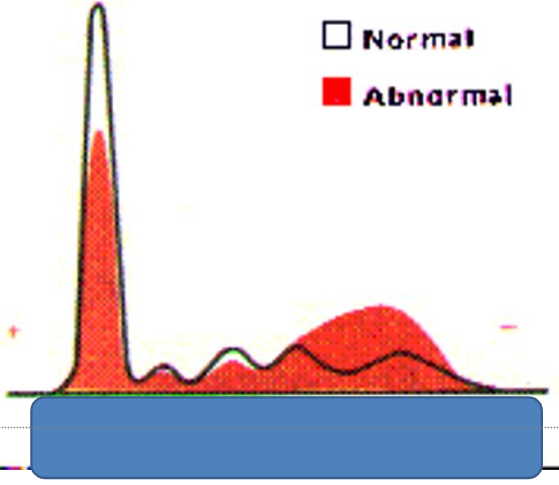 <p>nephrotic syndrome?? </p>
