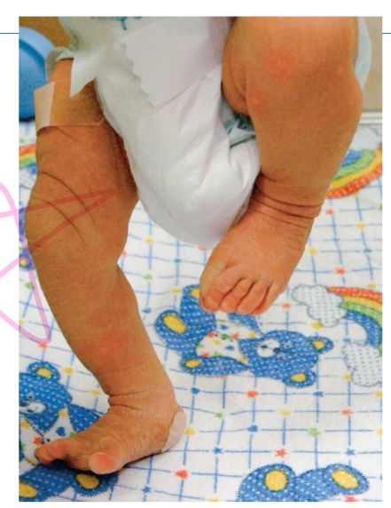 <p><span>an instinctive response that makes a baby appear to walk when held upright with their feet on a flat surface</span></p>