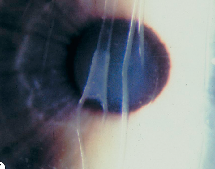 <p>from corneal enlargement (infantile glaucoma), birth trauma (forceps), or keratoconus</p>