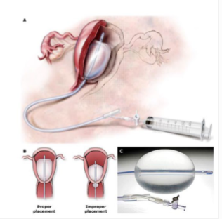 <p><strong>Postpartum Hemorrhage Management: Uterine Atony (Tone)</strong></p><p>-Fundal/uterine ________</p><p>-Bimanual compression/__________ of clots </p><p>-Uterotonic medications → __________, misoprostol, methergine, hemabate, cytotec, tranexamic acid </p><p>-Tamponade of uterus via bakri balloon or packing with gauze </p><p>-Uterine artery ligation</p><p>-Hysterectomy </p>
