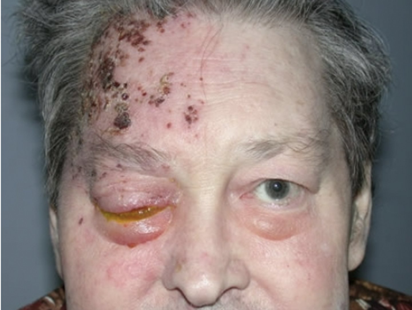 <p><u>Etio</u>: contagious, <strong>Varicella-zoster virus (VZV),</strong> <strong><mark data-color="#e8fa00" style="background-color: #e8fa00; color: inherit">CN V (Trigeminal) </mark></strong></p><p><u>Risk factors</u>: Hx of varicella infection, &gt;50 y/o, stress, immunosuppression</p><p><u>S&amp;S</u>: <strong><mark data-color="#fdfdfd" style="background-color: #fdfdfd; color: inherit">extremely painful,</mark></strong> unilateral, photophobia, blurred vision, tearing/ocular redness; <strong><mark data-color="#f4ff07" style="background-color: #f4ff07; color: inherit">prodromal: fever, malaise, HA, eye pain prior to vesicles</mark>; <u>Hutchinson signs: lesions on nose</u></strong></p><p><u>Complications:</u> vision loss, herpes zoster post, herpetic neuralgia</p><p>Testing: <strong><mark data-color="#faff00" style="background-color: #faff00; color: inherit">Tzanck smear or PCR</mark></strong>, direct fluorescent antibody testing</p><p><u>Tx</u>: <strong>IV Acyclovir</strong> 10mg/kg/dose OR <strong>Valacyclovir</strong> 1g TID, inpt admit to hospital; prevention: zoster vax, keep vesicles covered, don’t scratch</p>