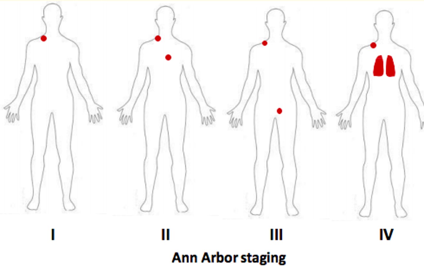 <p>Stage 1 </p><p>Lymphoma in single node region</p><p>Stage 2</p><p>Two separate regions on one side of diaphragm </p><p>Stage 3</p><p>Spread to both sides of the diaphragm </p><p>Stage 4</p><p>Diffuse or disseminated involvement of one or more extra-lymphatic organs such as bone marrow or lungs.</p>