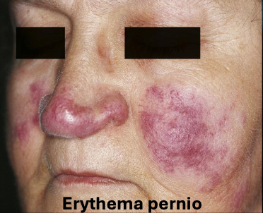 <p>A type of sarcoidosis that is chronic, purple and has indurated lesions on head and neck</p>