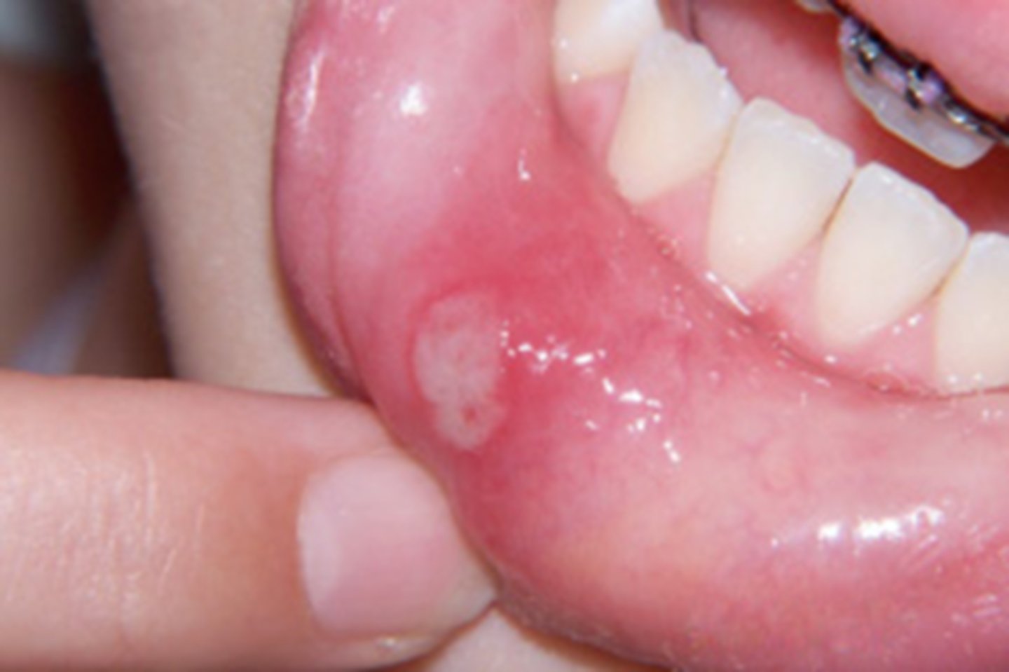 <p>from biting, braces, sharp tooth</p>