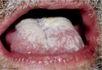 <p>-The tongueshows a superficial layer of a loose, cream-colored deposit</p><p>•Raised curdlikepatchesare present</p><p>-These patches can be removed, revealing an erythematous baseunderneath</p>