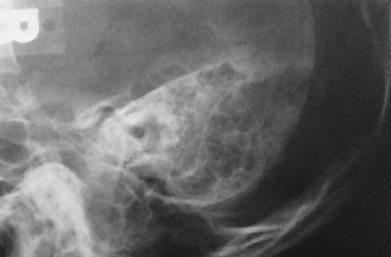 <p>What is this x-ray demonstrating?</p>