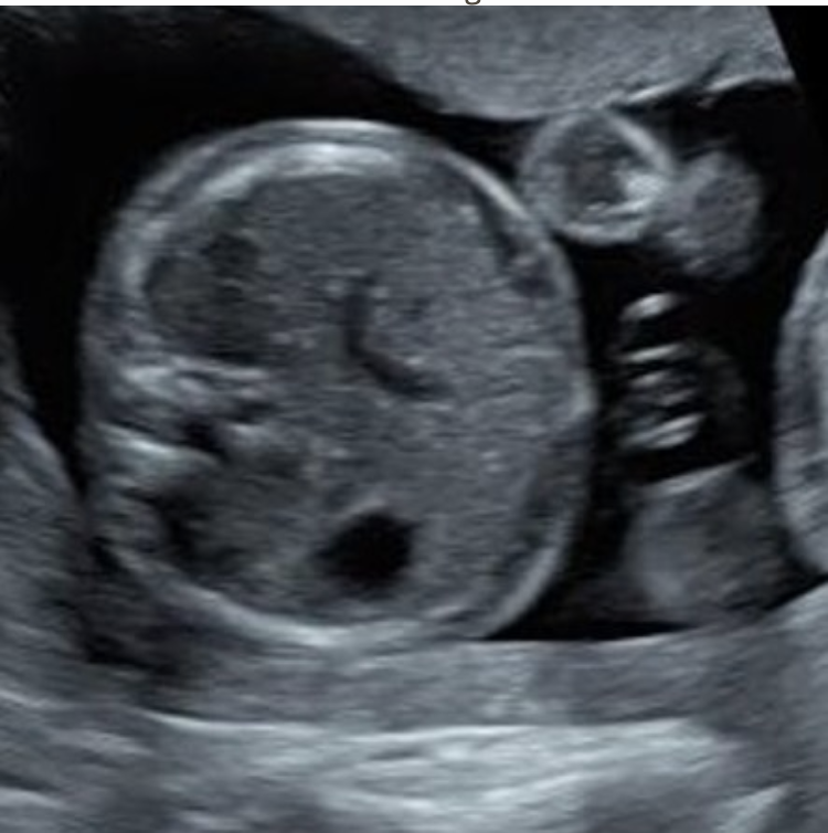 <p>what is shown here</p><p>a) persistent right umbilical vein</p><p>b) ascites</p><p>c) pseudoascites</p><p>d) omphalocele </p>