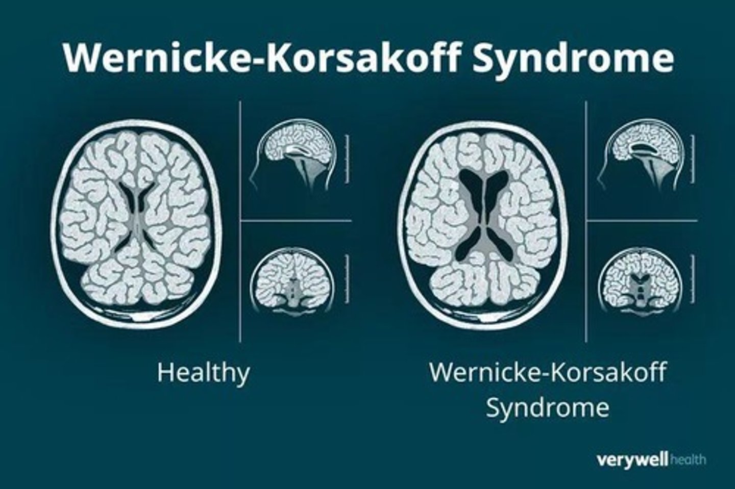 <p>Caused by thiamine deficiency; Symptoms: Difficulty forming new memories, memory loss, confabulation, hallucinations</p>