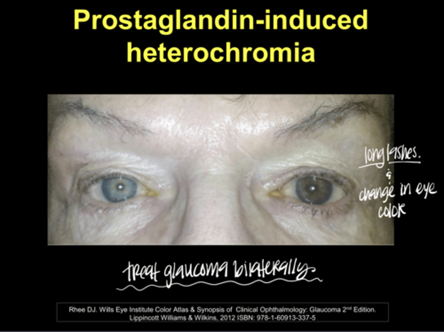 <p>Prostaglandin-Induced Heterochromia (Pic)</p><p>**why you treat glaucoma with prostaglandins bilaterally</p>