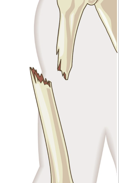 <p>Bone breaks through skin (aka open wound); risk of infection</p>