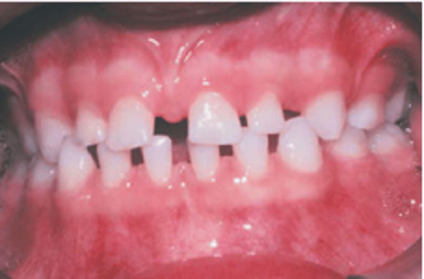 <p>A condition where teeth are abnormally small, often hereditary.</p>