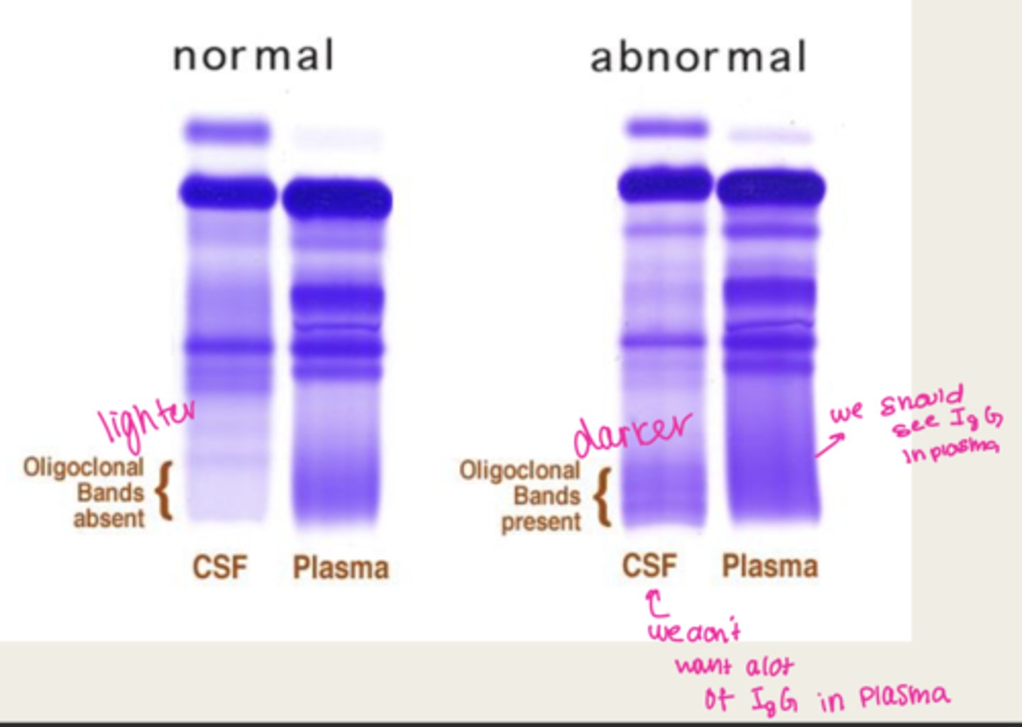 <p>dark oligoclonal bands</p>
