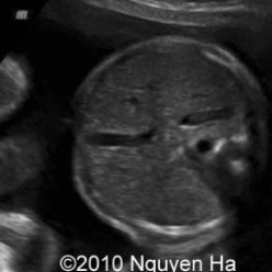 <p>The fetus scanned on had polyhydramnios. What can be assumed here?</p>