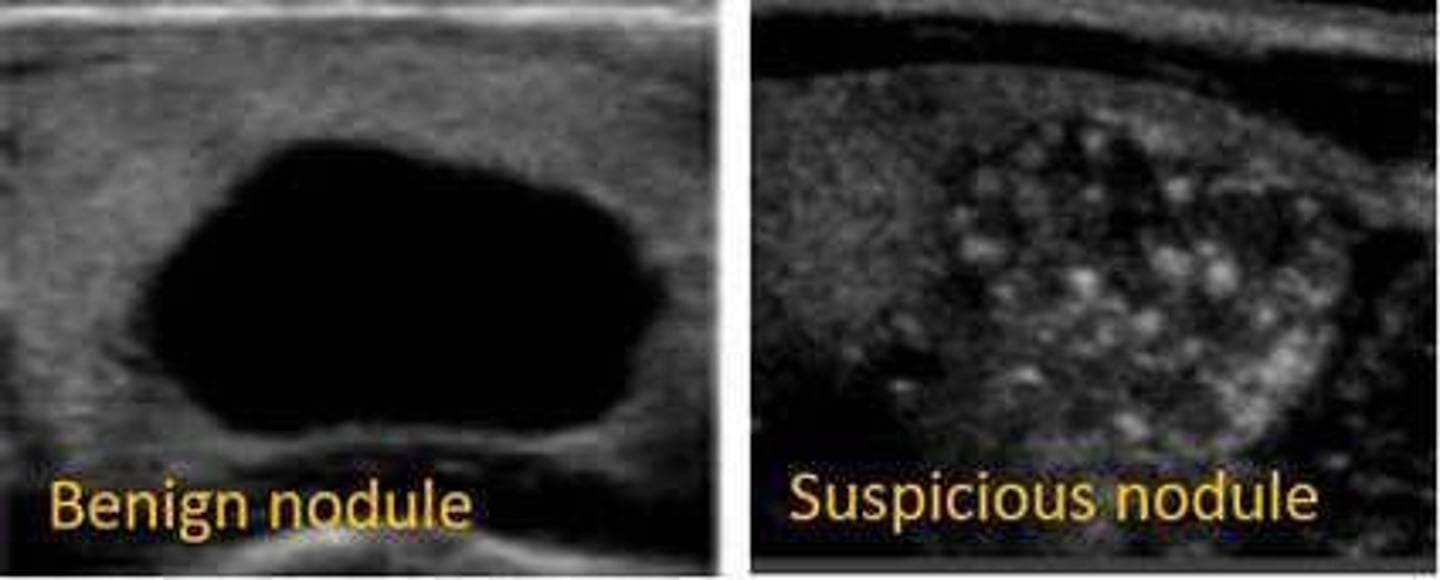<p>Thyroid ultrasound.</p>