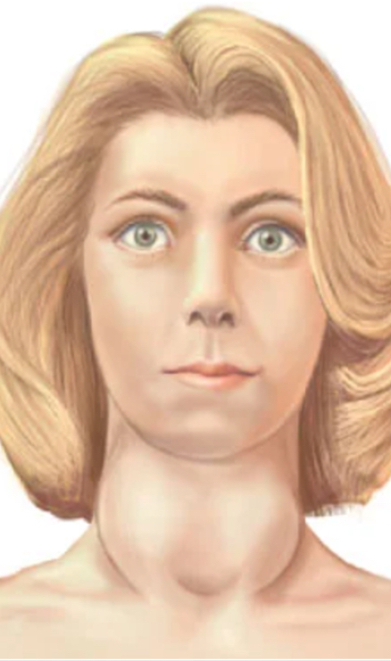 <p>an <strong>autoimmune </strong>disorder characterized by thyroid-stimulating immunoglobulins (<strong>TSI</strong>) or <strong>TSH </strong>receptor antibodies that <strong>abnormally activate the thyroid gland</strong></p><p>Hyperthyroidism w/ goiter and ophthalmopathy</p><ul><li><p>affects 0.5%-1% under 40yo</p></li></ul><p></p>