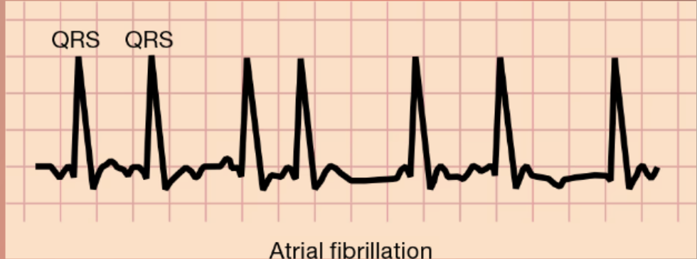 <p>Atrial Fibrillation</p>