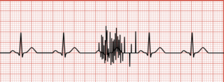 <p>Irregular spikes throughout the tracing related to muscle movement.</p>