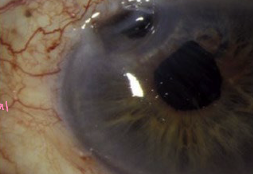 <ul><li><p><span>Tissue disintegration</span></p></li><li><p><span>in <em>severe</em> corneal disease</span></p></li><li><p><span>Corneal infiltrate may or may not be seen</span></p></li></ul><p></p>