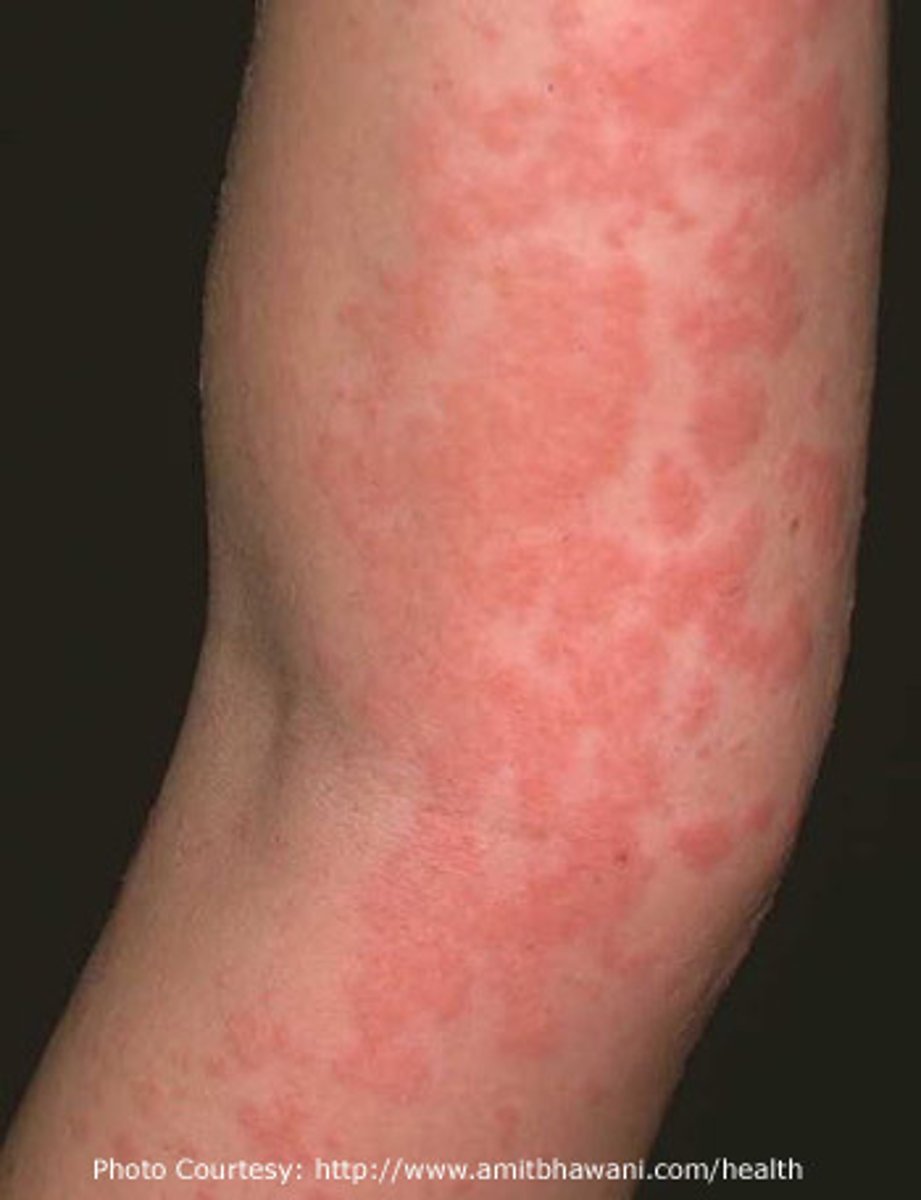 <p>-erythematous, edematous papules or <strong>wheals</strong> that develop on the skin in response to stimuli</p><p>-hives form in response to histamine when blood plasma leaks out of small blood vessels into the skin</p><p>-#1 symptom is pruritus</p><p><strong>-hallmark: lesions last less than 24 hours</strong></p>
