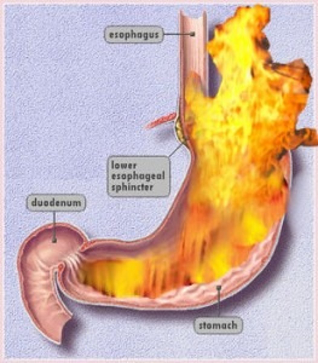 <p>The acidic secretion of the stomach. The liquid that includes hydrochloric acid and pepsin and that is responsible for the chemical digestion of protein in the stomach.</p>
