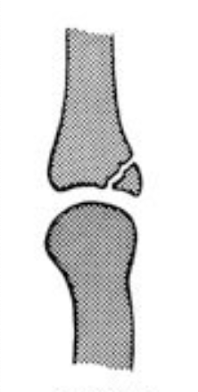 <p>What classification of fracture is this?</p>