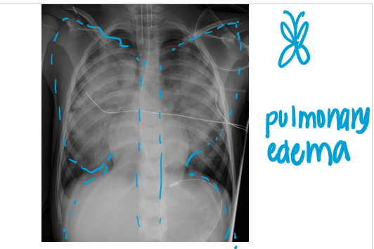 <p>pulmonary edema</p>