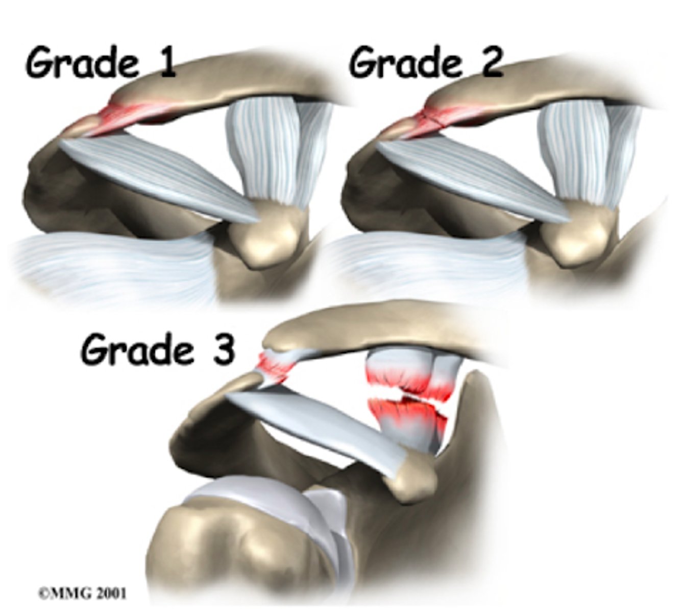 <p>I → partial disruption of AC ligaments; CC ligaments intact</p><p>- no separation</p><p>II → AC ligaments are torn; CC ligaments intact</p><p>- partial separation of clavicle from acromion</p><p>III → AC + CC ligaments are torn</p><p>- complete separation</p><p>**IV-VI = not common</p>