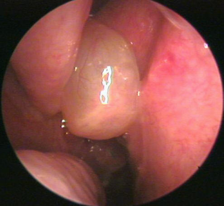 <p>pale, blue, edematous mass covered with mucosa</p>