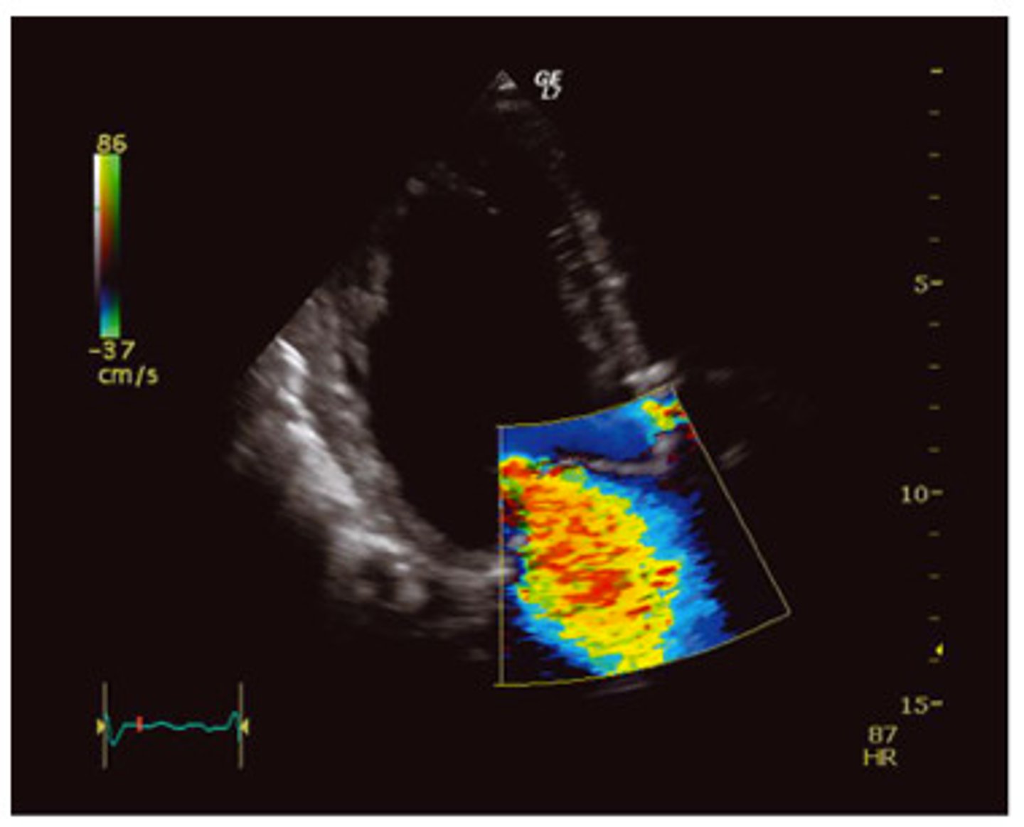 <p>disturbed flow</p>