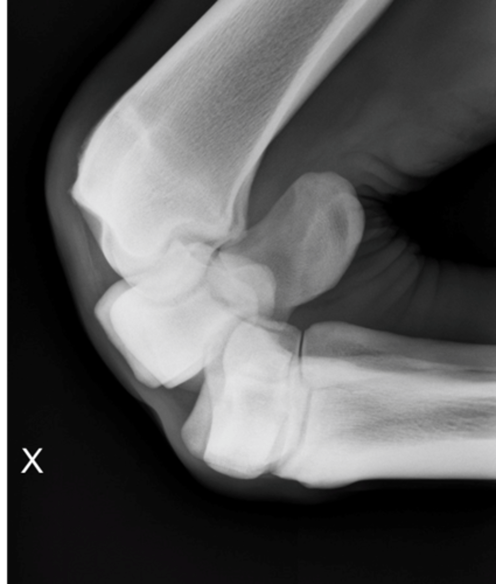 <p>How can you differentiate the intermediate carpal bone?</p>