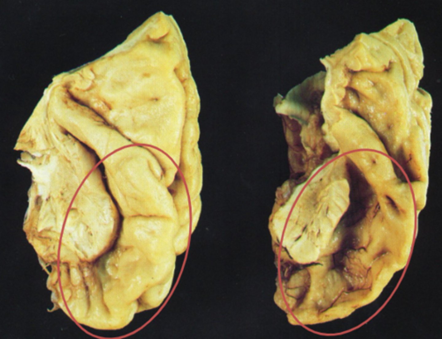 <p>As a result of changes in the auditory associative cortex</p>