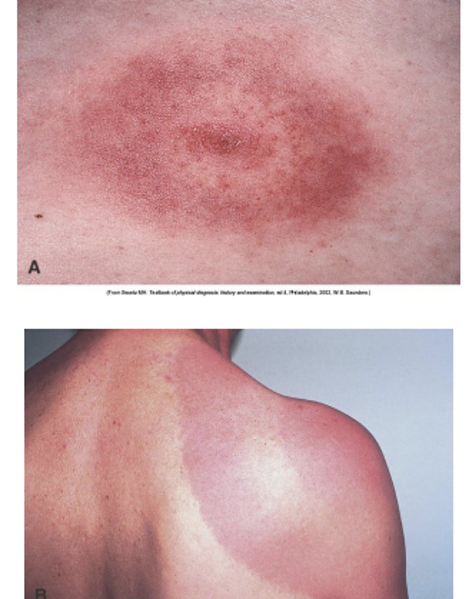 <p>infectious multi-systemic disorder</p><p>- Hallmark bullseye rash</p><p>Manifestations: flu-like onset</p><p>Unilateral poly-arthritis of large joints</p>