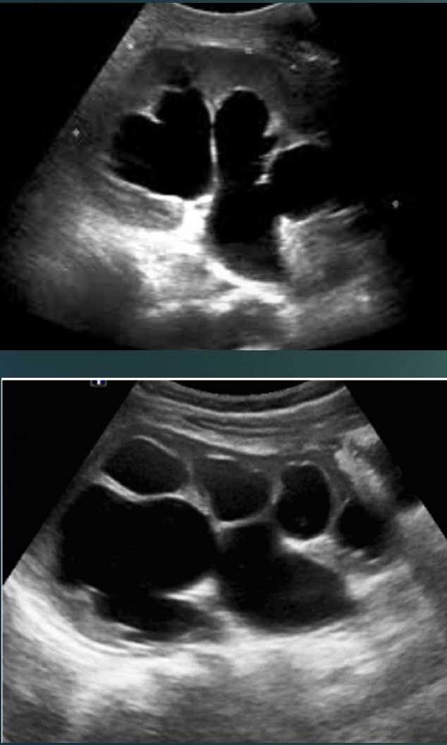 <p>Dilated calcyes : hydronephrosis </p>
