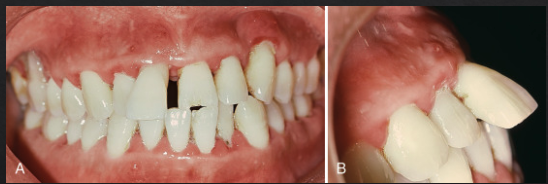 <ol><li><p>periodontitis&nbsp;</p></li><li><p>increased mobility&nbsp;</p></li><li><p>new interproximal gaps&nbsp;</p></li><li><p>tooth extrusion&nbsp;</p></li></ol><p></p>