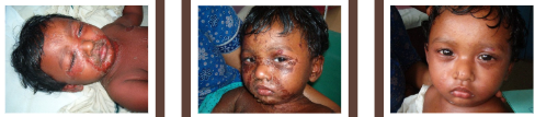 <p>Bacterial Skin Infections:</p><p>True/False:</p><p>In staph-scalded skin syndrome, babies and infants, even after treatment, often are affected in the long term by scarring and slow healing. </p>