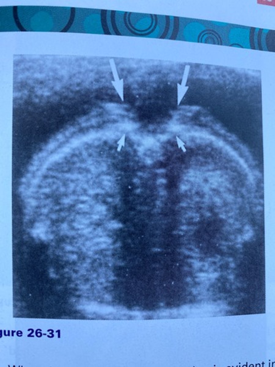 <p>Which of the following is demonstrated by the large arrows in Figure 26-31?</p><p>a. Spina bifida occulta</p><p>b. Open spinal defect</p><p>c. Kyphosis</p><p>d. Kyphoscoliosis</p>