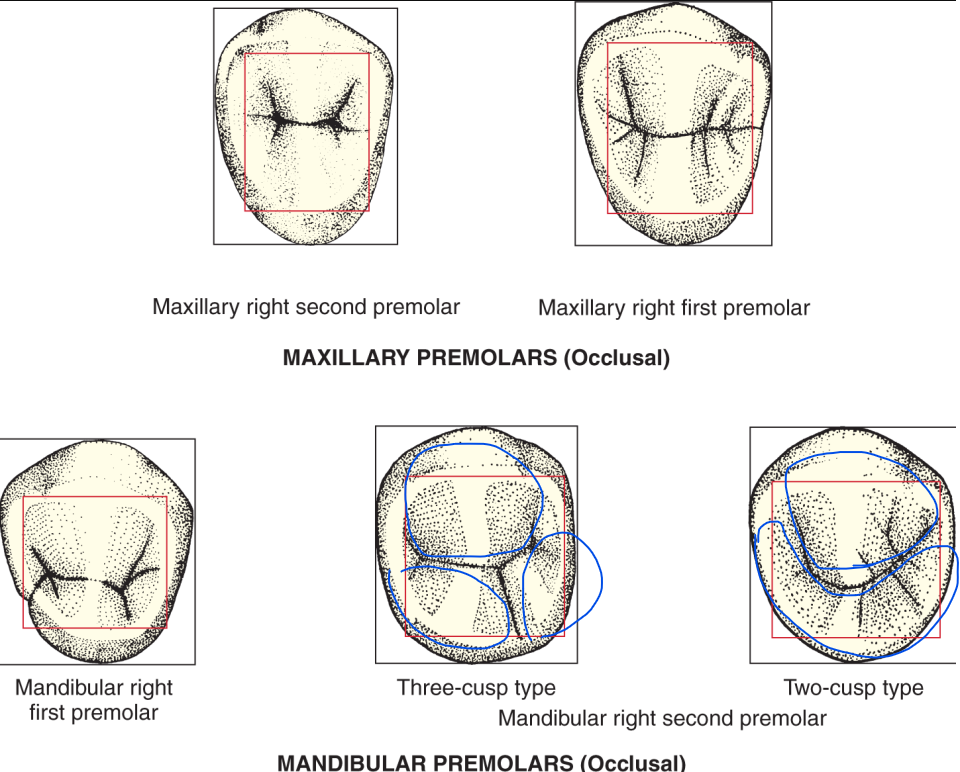 <p><strong>Mandibular 2nd premolars</strong> have several distinguishing features:</p><ul><li><p><strong>2 or 3 cusps</strong>:</p><ul><li><p><strong>3-cusp type</strong> (most common): </p><ul><li><p>1 buccal + 2 lingual (mesiolingual lobe is larger than distolingual lobe)</p></li><li><p>additional developmental groove  between two lingual cusps </p></li></ul></li><li><p><strong>2-cusp type</strong>: 1 buccal + 1 lingual</p></li></ul></li><li><p><strong>Occlusal patterns</strong>:</p><ul><li><p><strong>Y-shaped</strong> (3 cusps)</p></li><li><p><strong>H-, U-, C-shaped</strong> (2 cusps)</p></li><li><p>2 Pits </p></li></ul></li></ul><p></p>