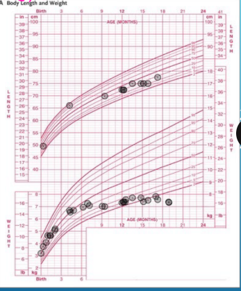 <p><strong>Abnormal Growth Patterns</strong></p><p>-Inadequate caloric intake → _______ percentile falls first, followed by ______ then HC</p><p>-Hypothyroidism → ____________ weight but falling _______ percentile </p><p>-Large HC → familial megalocephaly, hydrocephalus, brain ______</p><p>-Small HC → premature closure of __________</p><p>-Pay attention to sudden, extreme, or persistent declines in growth </p>
