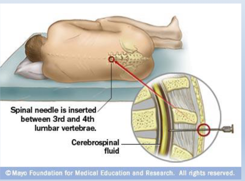 <ul><li><p><span>Spinal tap/epidural</span><br><span>• CSF can be collected for testing (i.e. meningitis)</span><br><span>• Drugs can be delivered into the CSF (intrathecal administration)</span></p></li></ul><p></p>