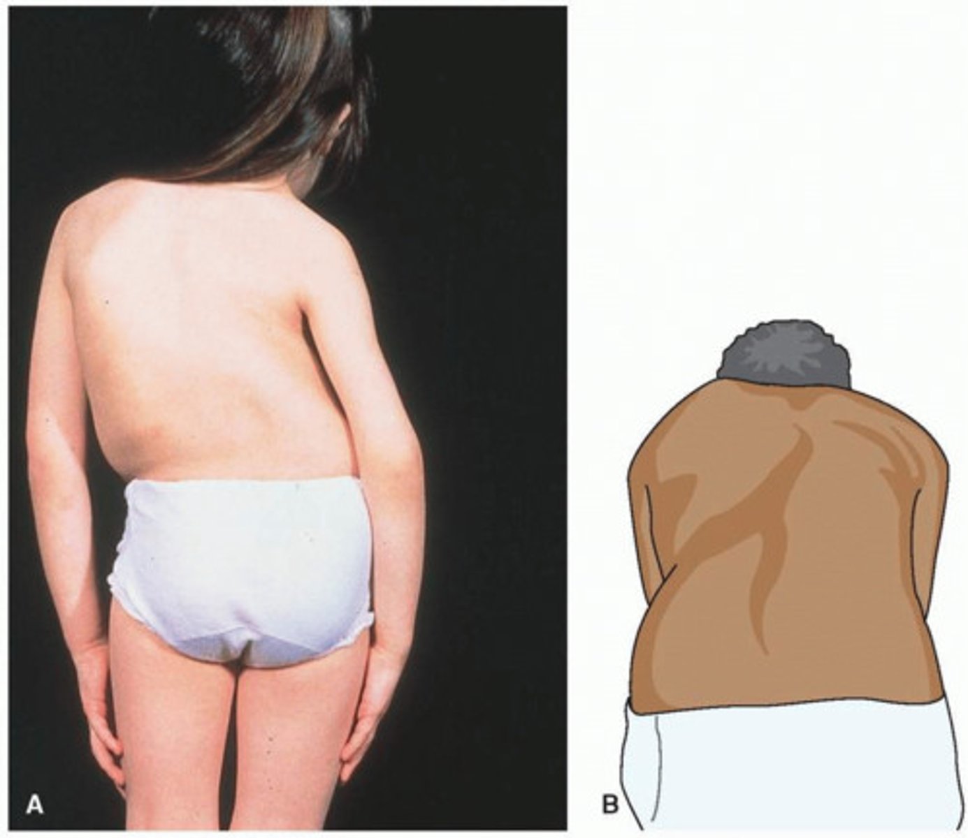 <p>BONEY ABNORMALITY</p><p>*fixed lateral deformity that does not correct with bending</p><p>1. congenital</p><p>2. neuromuscular</p><p>3. idiopathic</p><p>infantile--&gt; under 3</p><p>juvenile--&gt; 3-10 yrs</p><p>adolescent--&gt; 10-skeletal maturity</p>