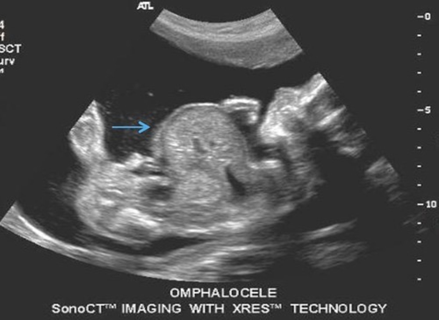 <p>Contains only bowel</p><p>80% association with aneuploidy's</p>