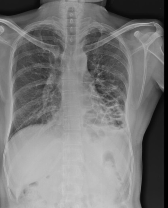 Permanent __dilatation of the airways__ secondary to chronic infection or inflammation

\
**Causes:**

* post-infective e.g. Tb, measles, pertussis, pneumonia
* CF
* bronchial obstruction e.g. lung cancer, foreign body
* immune deficiency e.g. selective IgA, hypogammaglobulinemia 

\
ECG showing tramlines (bronchial wall thickening), prominent in left lower zone