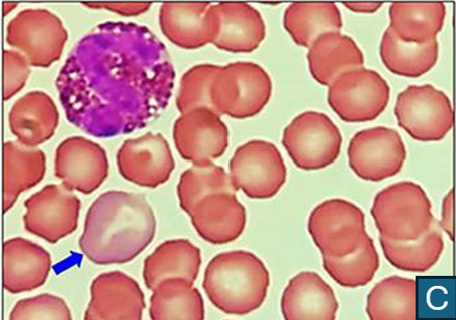 <p>Indicate what kind of cell is in the blood smear. Describe why it looks that way.</p>