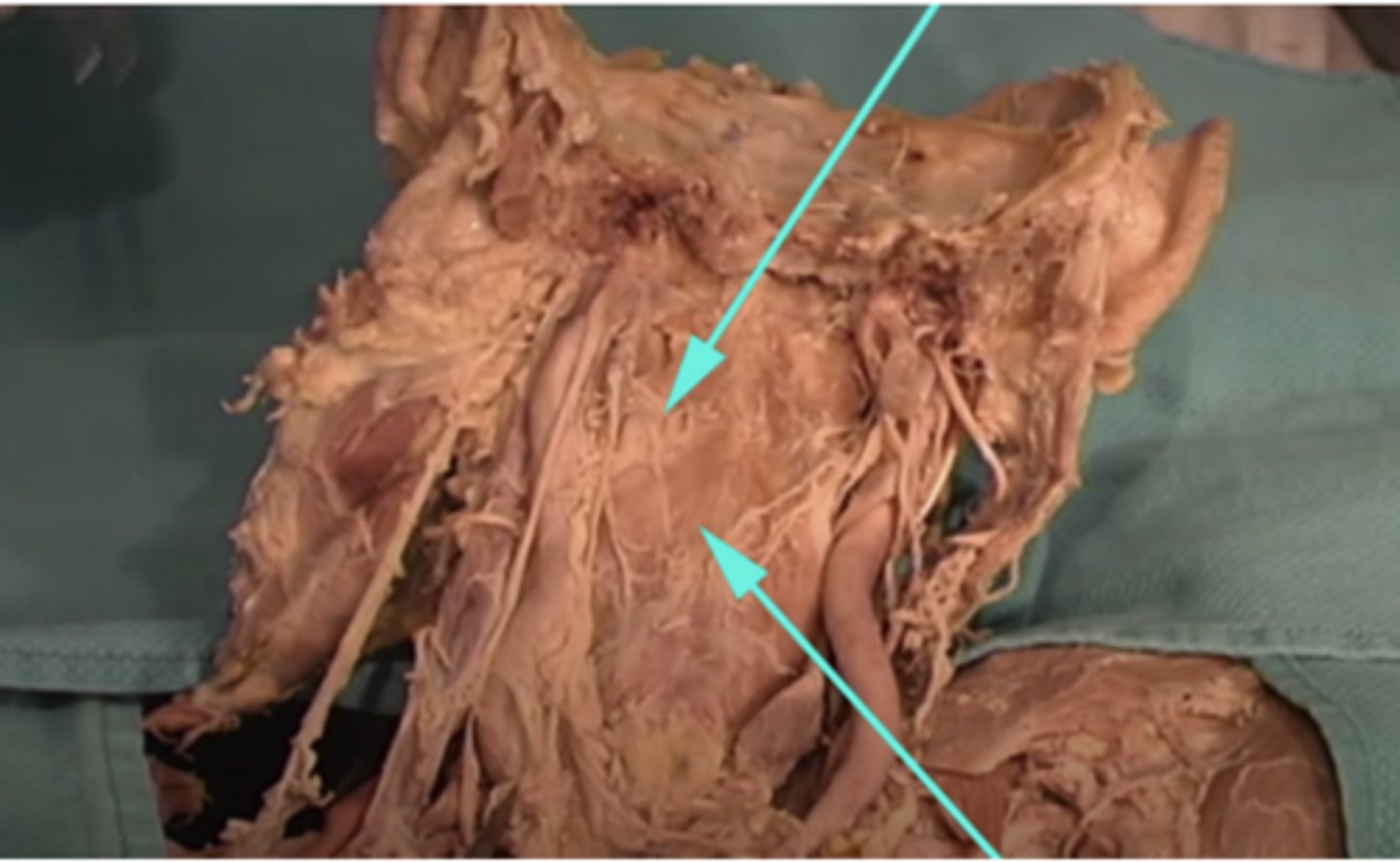 <p>What is this region as indicated by the arrows?</p><p>-the front of the pharynx</p><p>-pectoralis major</p><p>-subcutaneous fascia</p><p>-the back of the pharynx</p>