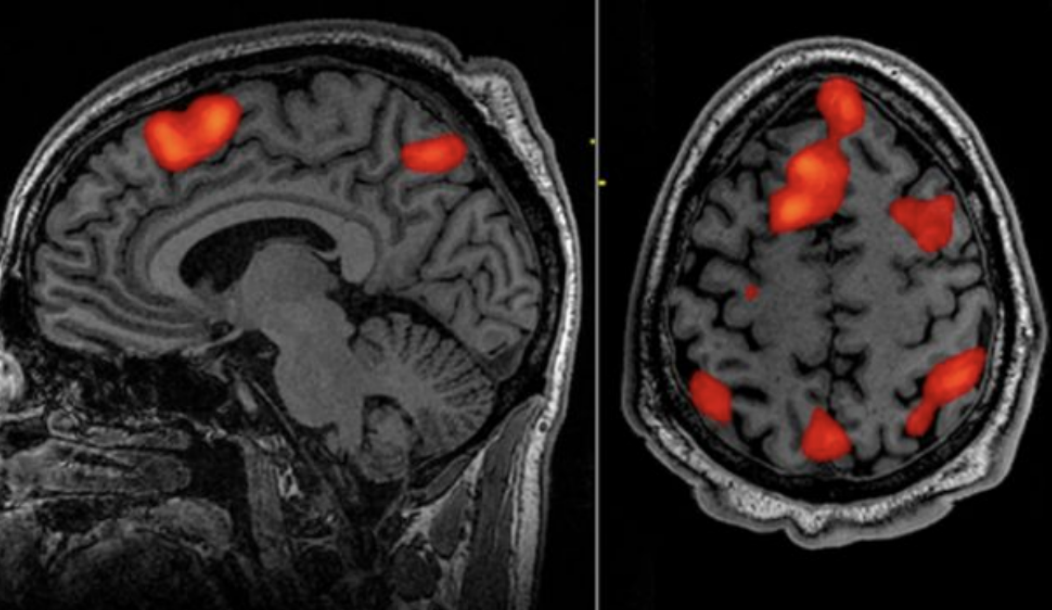 <p><span><mark data-color="green">Functional Magnetic Resonance Imaging:</mark> measures and maps brain activity by detecting changes in blood flow to produce images showing which parts of the brain are activated during specific tasks or in response to stimuli.</span></p>